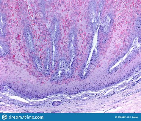 Skin Molluscum Contagiosum Stock Image Image Of Bodies Histology