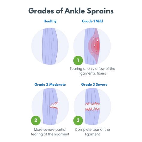 Ankle Sprain Recovery Time The Frankel Foot And Ankle Center