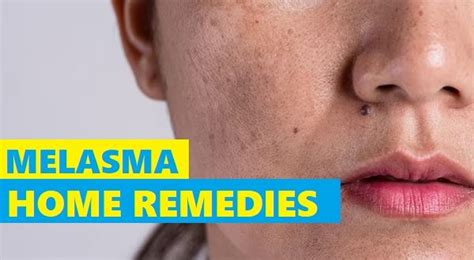 Top 10 Home Remedies To Cure Melasma Naturally Tips And Beauty