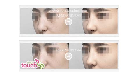 Best Korean Advanced Rhinoplasty Before And After Compliation Seoul