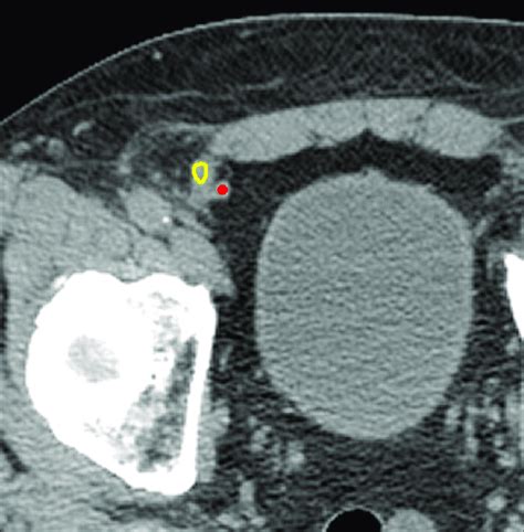 Amyand Hernia Color Coded Ct Image Shows The Appendix Yellow Within