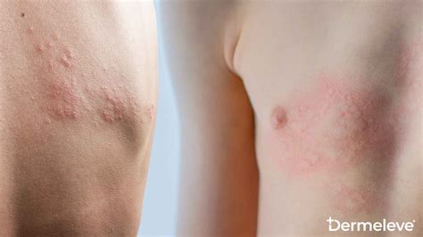 Hives Vs Rash How To Tell The Difference Dermeleve®