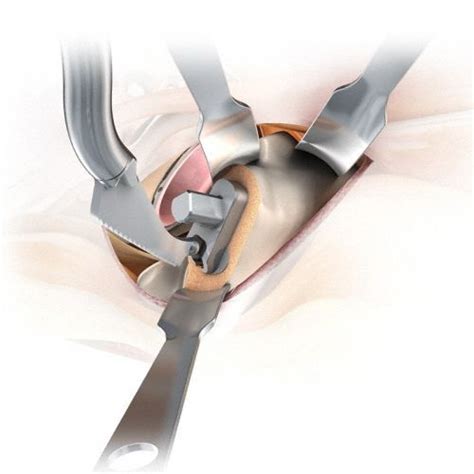 Kit D Instruments Pour Chirurgie De La Hanche Mini Invasive MIOS Aesculap