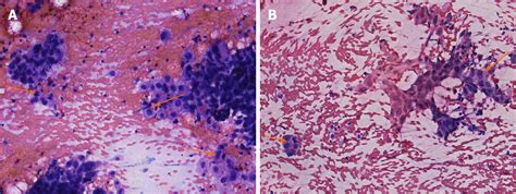 Metastasis Of Esophageal Squamous Cell Carcinoma To The Thyroid Gland