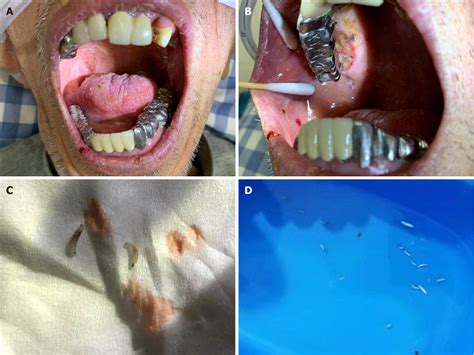 Figure 1 From Oral Myiasis After Cerebral Infarction In An Elderly Male Patient From Southern