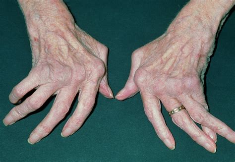 Womans Hands Crippled With Rheumatoid Arthritis Photograph By Dr P