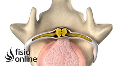 ¿qué Es Un Hernia Discal Causas Y Síntomas Fisioonline