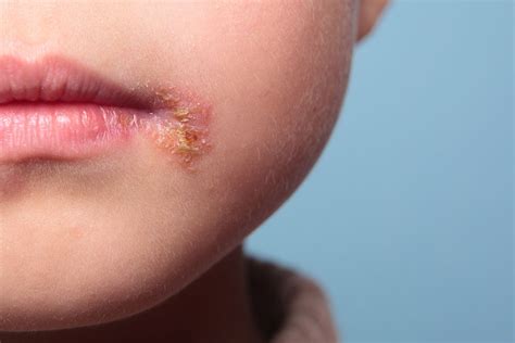 Rashes And Spots Pictures In Toddlers Children And Babies Nhs Doctor