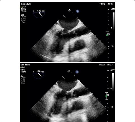 Post Operative Echography Showing Minimal Residual Fenestration In Left