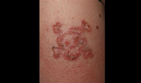 Black Henna Tattoos Can Cause Severe Skin Reactions Case Shows Live