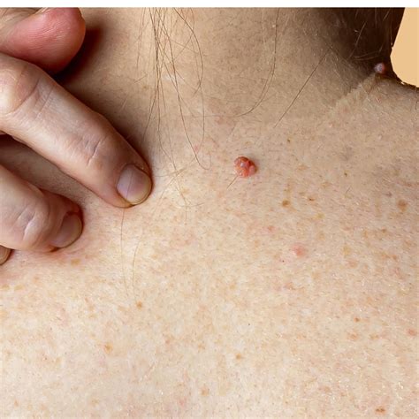 Skin Cancer Lesions Images
