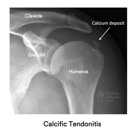 Calcific Tendonitis Shoulder Conditions Sydney Shoulder Unit