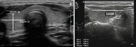 Thyroid Gland And Ultrasound Applications Pocket Dentistry