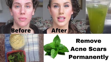Mint Remedies To Remove Your Dark Spots Acne Pigmentation Andpimples