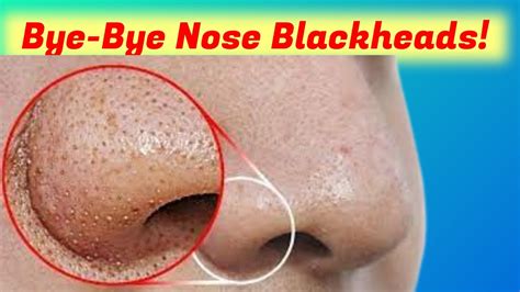 How Get Remove Blackheads On Nose How Get Rid Blackheads On Nose