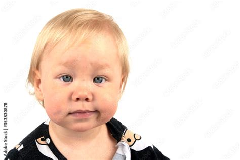 Portrait Of A Little Boy With Bruise On His Forehead And Cheek Isolated