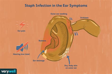 Qué Causa Las Infecciones Por Estafilococos En El Oído Y Cómo Tratarlas