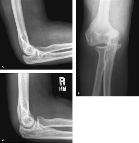 Treatment Of Acute Elbow Dislocations Teachme Orthopedics