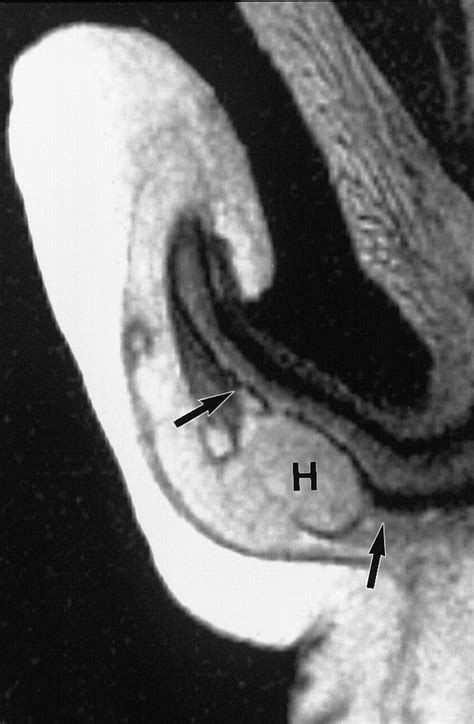 Mr Imaging Of Acute Penile Fracture Radiographics