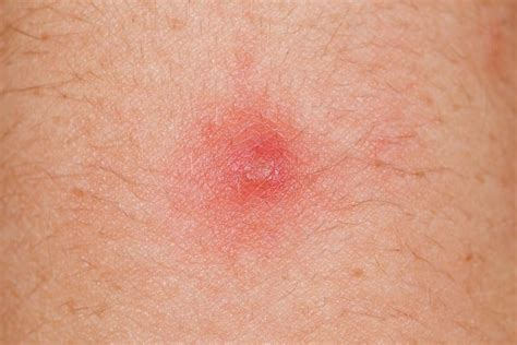 Bumps On Testicles Sack Laxenchallenge
