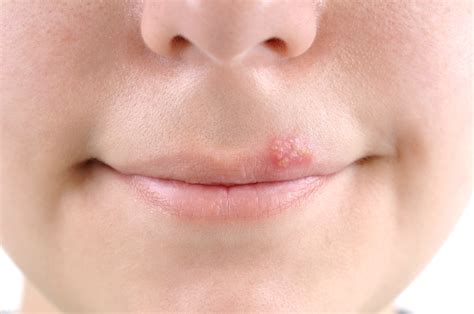 What Do Pimples On Lips Mean