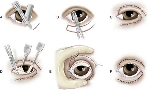Basic Ophthalmic Surgical Procedures Veterian Key