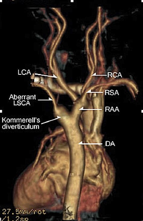 The 3d Reconstruction Of 64 Slices Ct Angiography Of The Right Aortic