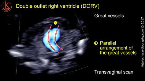 Fetal Echocardiography At 11 13 Weeks Double Outlet Right Ventricle