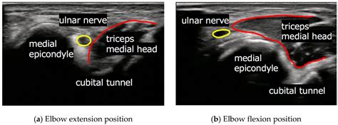 Jcm Free Full Text Ulnar Nerve Dislocation And Subluxation From The