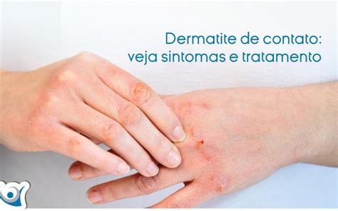 Dermatite De Contato Veja Sintomas E Tratamento Alergocl Nica