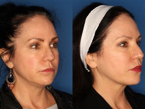 Kybella Before And After Kybella