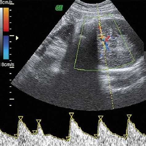 Doppler PW Of The Middle Cerebral Artery At 38 GW Fetus With Multiple