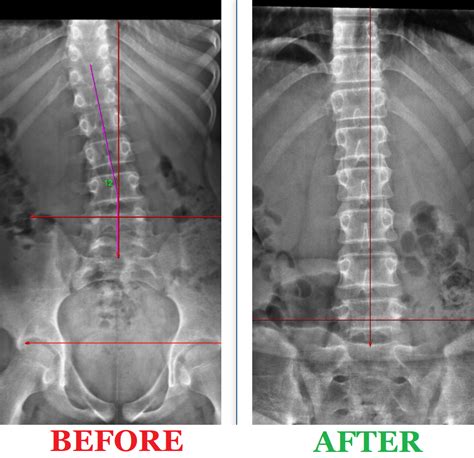 Digital Spine X Rays Camarata Chiropractic