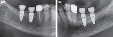 Extracts From Postoperative Opg Gingival Former In The Third And