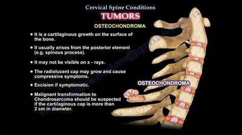 Cervical Spine Conditions Tumors Everything You Need To Know Dr