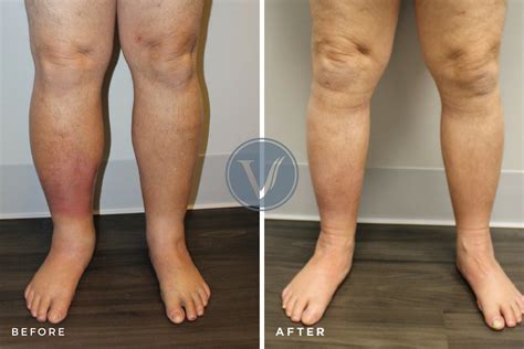 Treatment Of Superficial Venous Disease The Vein Institute At Ssa