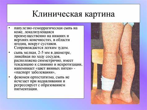 Диета геморрагического васкулит Лечение геморрагического васкулита у детей и взрослых Лечение геморрагического васкулита у детей и взрослых Диета геморрагического васкулит