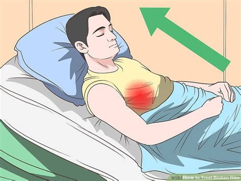 How To Treat Broken Ribs Steps With Pictures Wikihow