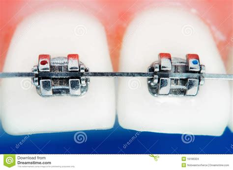 Front Teeth Braces Stock Photo Image Of Braces Ligature 16166324