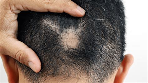 Bald Spots Hair Transplant All You Need To Know 2024