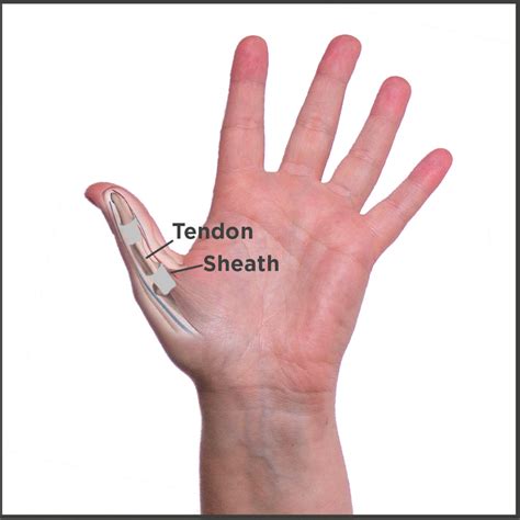 Trigger Finger Thumb Treatment Symptoms Causes Surgery And Exercises