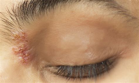Characteristics Treatment And Complications Of Herpes Zoster Ophthalmicus At A Tertiary Eye