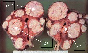 Myom cerrahisinde günümüzde yaygın olarak kullanılır. Myom-Embolisation > Institut für Diagnostische und ...