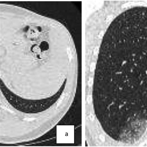 Axial A And Coronal B Section Lung Window Of Ct Chest Angiography