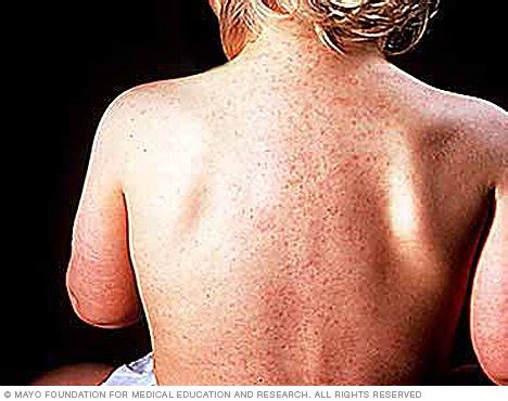 He does not have active infection, these rashes are not related to hsv. Roseola Disease Reference Guide - Drugs.com