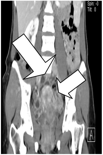 Black Spots On Ct Scan Of Abdomen Ct Scan Machine Images And Photos