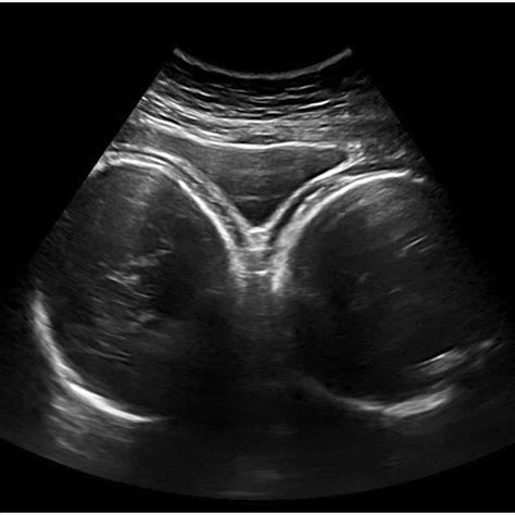Intraoperative Photos Of Uterus Didelphys During Cesarean Section A