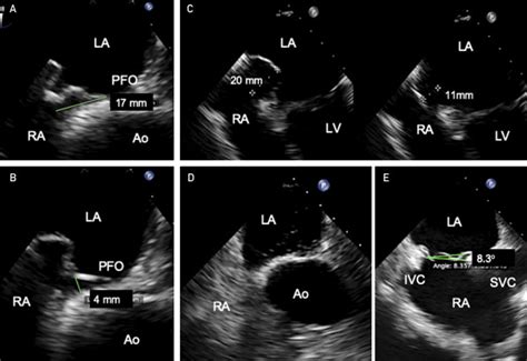 Patent Foramen Ovale High Risk Anatomy Mayo Clinic Proceedings