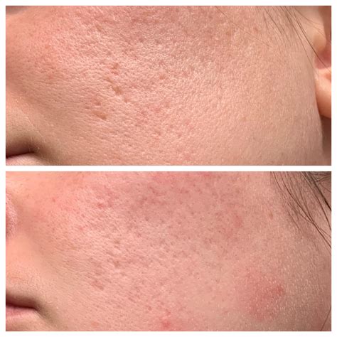 Update Two Months Progress On 0025 For Acne Scars Rtretinoin
