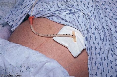 Percutaneous Endoscopic Gastrostomy Peg Dr B C Shah Feeding Tube